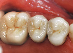 All-ceramic crowns