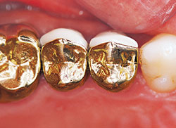 metal crowns